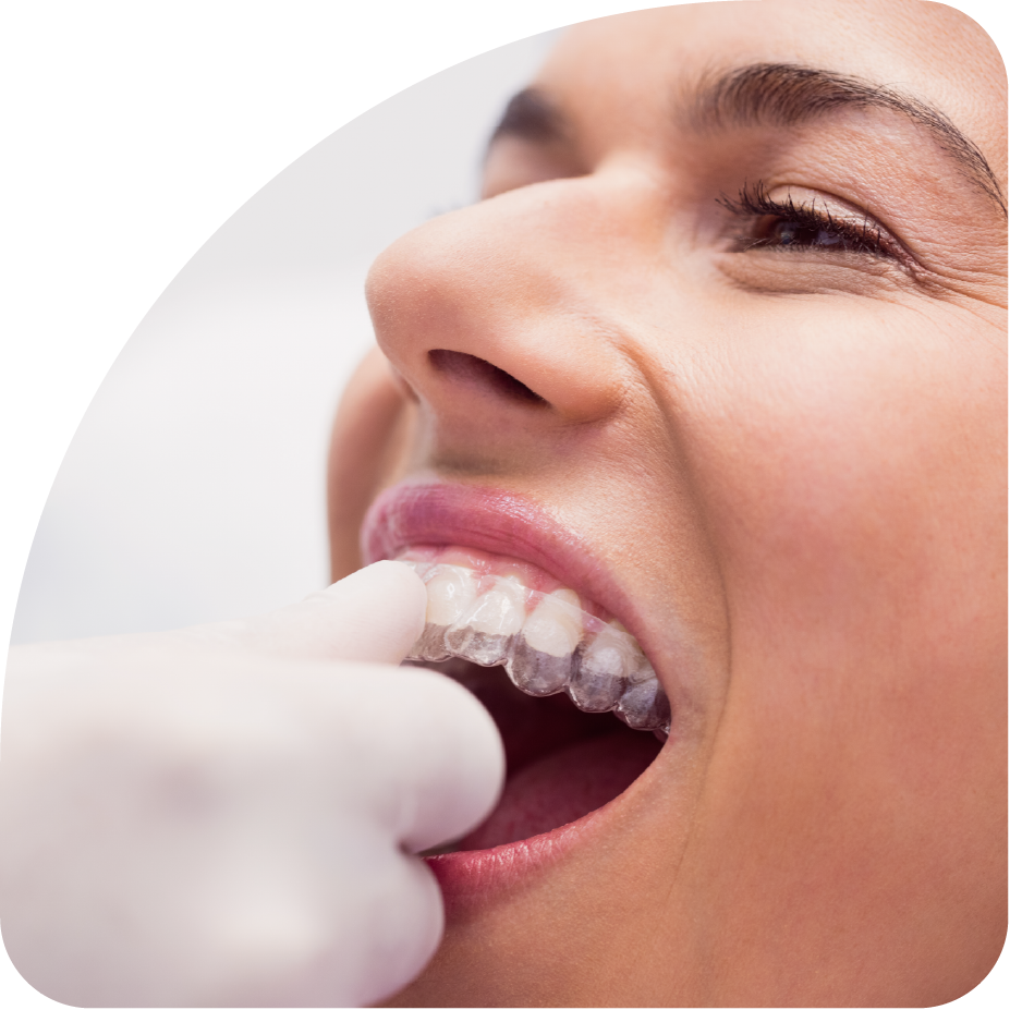 aligner orthodontie den hoorn ortho laak den haag aligner orthodontie den hoorn ortho laak den haag