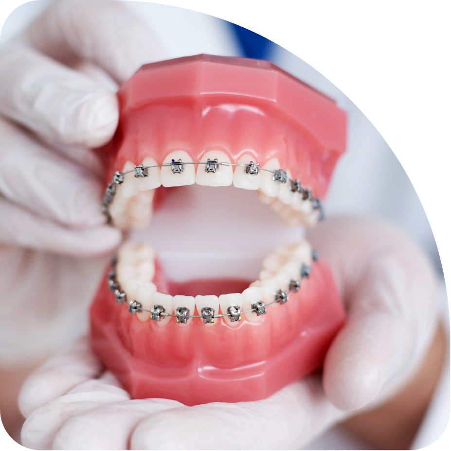 beugel orthodontie den hoorn ortho laak beugel orthodontie den hoorn ortho laak